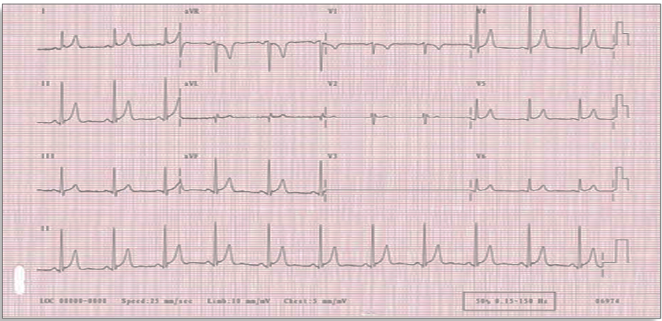 Question 1 EKG