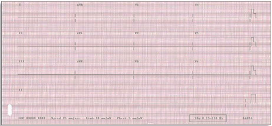 Question 10 EKG