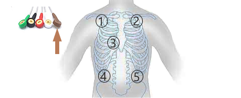 Question 3 EKG.2a