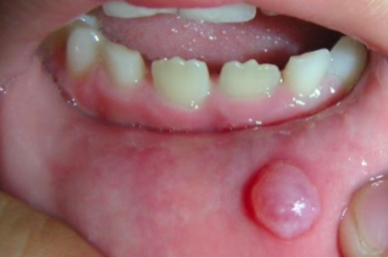 A circumscribed, elevated lesion that is more than 5 mm in diameter  Usually contains serous fluid, and looks like a blister