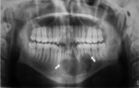 Describes a lesion that extends beyond the confines of xxone distinct area  Defined as many lobes or parts that are somewhat fused together   A multilocular radiolucency is sometimes described as resembling soap bubbles