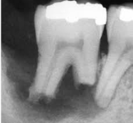 Arises from tissue outside the tooth, such as the periodontal ligament