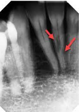 Triggered by pulpal tissue reaction from within the tooth  The pulpal area can be seen as a diffuse radiolucency beyond the confines of the normal pulp area