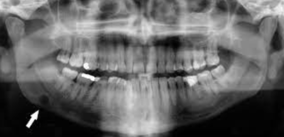 Often referred to as a pseudocyst  Characterized by a well defined radiolucency in the posterior region of the mandible, infererior to the mandibular canal    Caused by a lingual depression in the mandible 