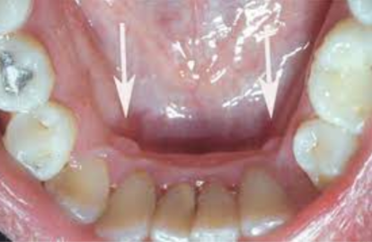 A sessile nodule xxon the gingival margin of the lingual aspect of the mandibular cuspids  xxOnly a few millimeters in size  Observed more often in young  Resolves with age