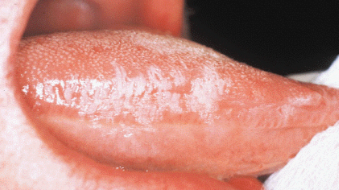 This lesion is most likely caused by the Epstein-Barr virus 