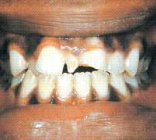 The most common supernumerary tooth 