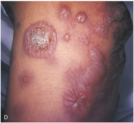 Erythema Multiforme