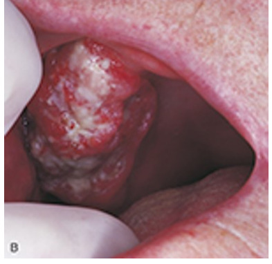 Veruccous Carcinoma