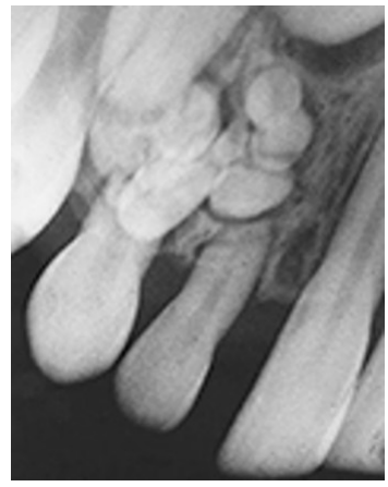 Compound odontoma